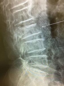 図①Aのレントゲン画像。初診時、第三腰椎圧迫骨折を疑う。