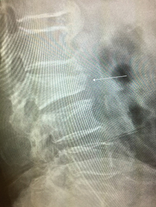 図①Cのレントゲン画像。１カ月後、さらに圧迫骨折が進行。