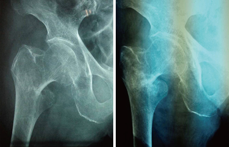 図②のレントゲン画像。２週間程度経過後に再度撮影し、大腿骨頸部骨折と診断。